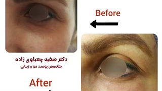 فیلم واقعی رفع گودی زیر چشم