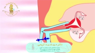 درمان ناباروری به روش لقاح داخل رحمی
