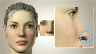 تفاوت بینی گوشتی و استخوانی