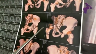 در رفتگی مفصل ران