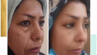 لیفت کامل پیشانی و شقیقه