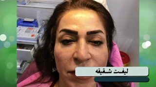 رضایت مراجعه کننده عزیزمون لیفت شقیقه