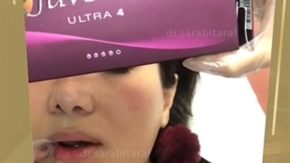 قبل و بعد از تزریق ژل لب به روش روسی