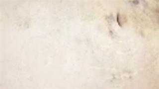 جادوی لاغری با لیپوماتیک