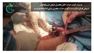 اولین تعویض مفصل دوطرفه لگن همزمان در شیراز