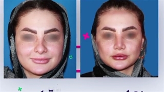 نتیجه قبل و بعد از جراحی بینی گوشتی