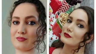 نمونه عمل بینی دکتر شهسواری