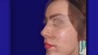 نمونه کار لیفت صورت دکتر خوروش