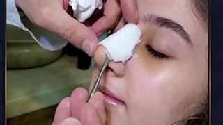 فیلم رضایت بیمار چهار روز بعد از عمل بینی