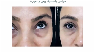 فیلم رفع پف و گودی زیر چشم