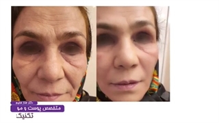 تکنیک تزریق برای لیفت صورت و بهتر شدن عمق خطوط خنده با نخ و ژل