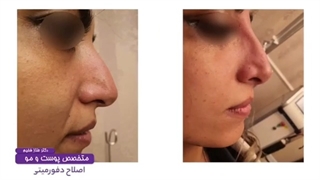 تزریق فیلر بینی و لیفت نوک بینی جهت اصلاح بینی