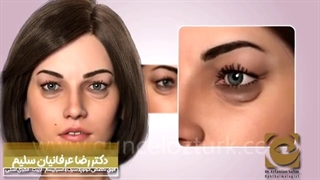 انیمیشن جذاب بلفاروپلاستی