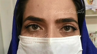 قبل و بعد از جراحی بلفاروپلاستی پلک