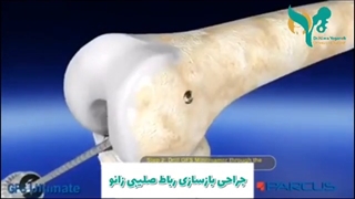 جراحى بازسازى رباط صلیبى زانو