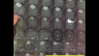 مننژیوم اتیپیکال سوپریور ساژیتال سینوس