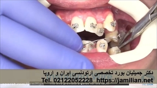 طریقه نصب براکت ها و سیم های ارتودنسی / متخصص ارتودنسی / دکتر جمیلیان