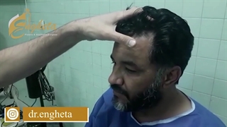 جراحی ترکیبی لیفت ابرو و بلفاروپلاستی