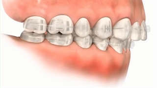دستگاه فانکشنال.متخصص ارتودنسی تهران.دکترعلیرضاخدیوی
