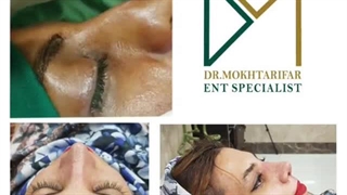 سه هفته پس از جراحی بینی مراجعه کننده عزیزمون