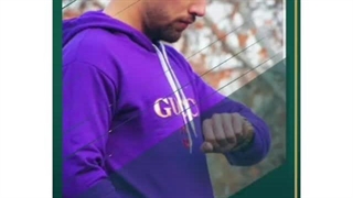 حدود یک سال پس از جراحی زیبایی در بینی گوشتی با کمبود بافت و ضعف غضروفی شدید