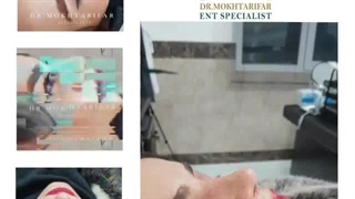حدود دو ماه پس از جراحی زیبایی بینی گوشتی با پوست ضخیم