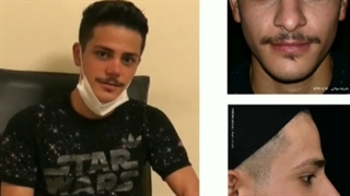 عمل جراحی بینی گوشتی