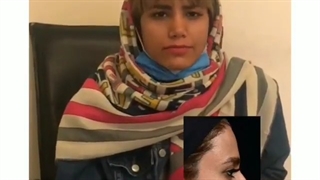 یکسال و سه ماه بعد از جراحی بینی گوشتی