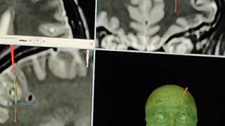 جراحی آدنوم هیپوفیز در خانم جوان