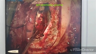 فیلم واقعی تومور مغزی