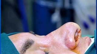 جراحی زیبایی بینی