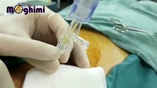 عمل بدون سانسور جراحی لیزری دیسک کمر در بیمار ۳۹ ساله