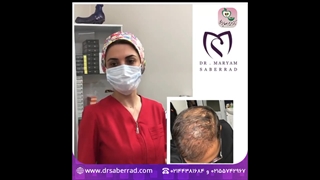 تزریق هیرفیلر