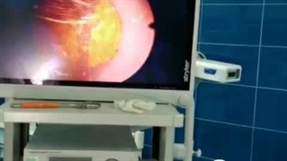 جراحی و خارج کردن سنگ مثانه 3 سانتی متری به روش آندوسکوپیک یا PCCL