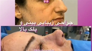 عمل زیبایی بینی و بلفاروپلاستی