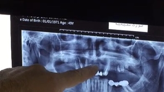 کاشت 14 واحد ایمپلنت دندان در یک جلسه توسط دکتر شهرام اسعدی بررسی لک صورت