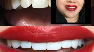 نتیجه کامپوزیت دندان