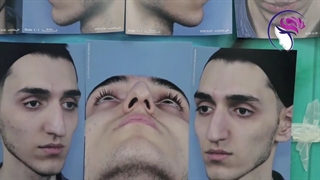 فیلم واقعی جراحی بینی مردانه با قوز شدید در اتاق عمل