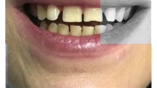 نمونه کامپوزیت دندان