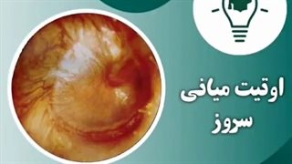 اوتیت میانی سروز