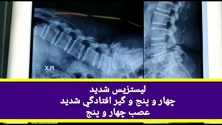 لیستزیس شدید چهار و پنج و گیر افتادگی شدید عصب چهار و پنج