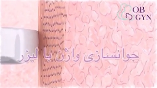 فیلم جوانسازی واژن با لیزر