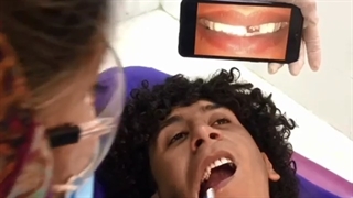 کامپوزیت ونیر دندان