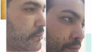 لیفت پیشانی و شقیقه و اصلاح فرم چشم ها