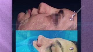 جراحی زیبایی بینی | دکتر سید رضا رفیع بهترین جراح بینی تهران