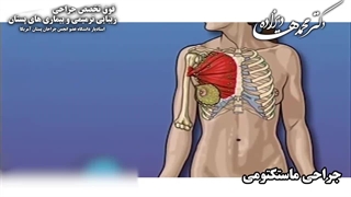 انیمیشن جراحی ماستکتومی ( برداشتن بافت سینه ) | دکتر هادیزاده