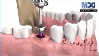 دکتر امیر محمدی - کاشت دندان و ایمپلنت اصلاح فرم صورت