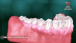 مراقبت های پس از جرمگیری دندان کودکان