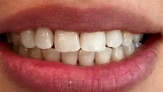 اصلاح طرح لبخند