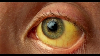 ۱۴۰۰ نکته هاریسون  یرقان بخش دوم دکترعلی فلاحیان